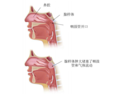 因为大意，外甥女住院了4天，同事的娃也中招了……